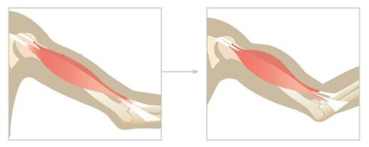 Super Inductive System (SIS) BTL аппарат высокоинтенсивной магнитотерапии для миостимуляции мышц