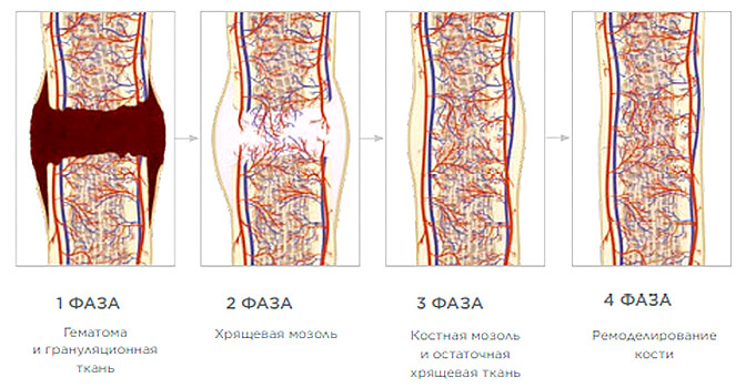 Super Inductive System (SIS) BTL аппарат высокоинтенсивной магнитотерапии для заживления переломов