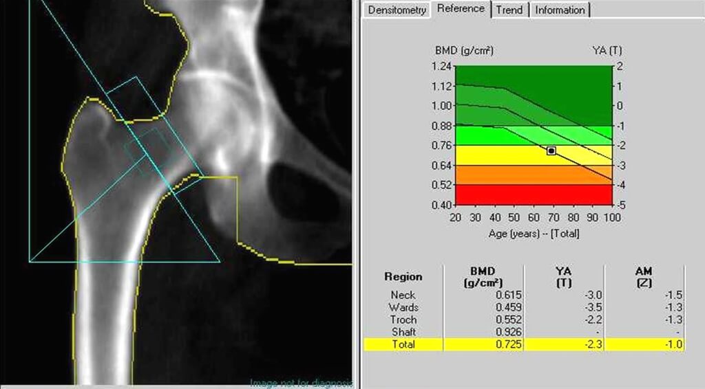 Рентгеновские денситометры - пример результата обследования