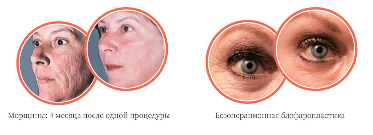 Косметологический лазер Slim Evolution II - Области применения