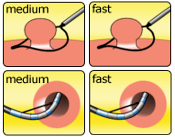 ЭХВЧ гастроэндоскопия