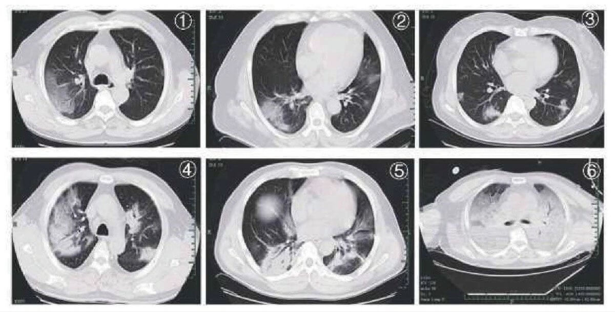 Признаки COVID19 на снимках компьютерной томографии