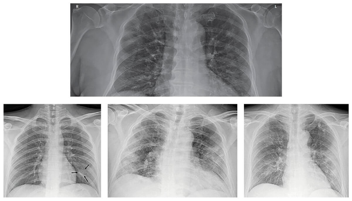 Рентгенография при диагностике COVID-19