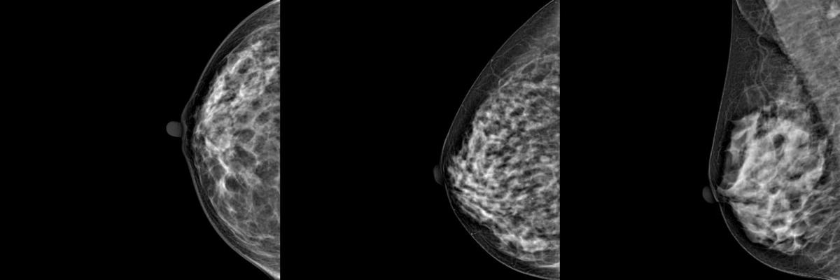 Цифровой маммограф Genoray DMX-600 - Примеры снимков маммографии