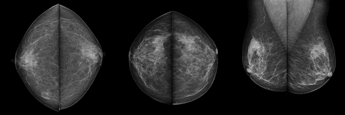 Аналоговый маммограф Genoray MX-600 - Примеры снимков маммографии