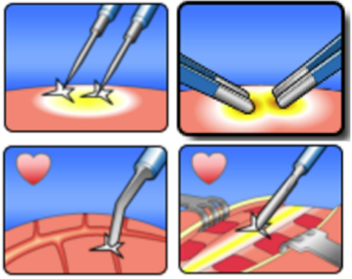 ЭХВЧ коагуляция