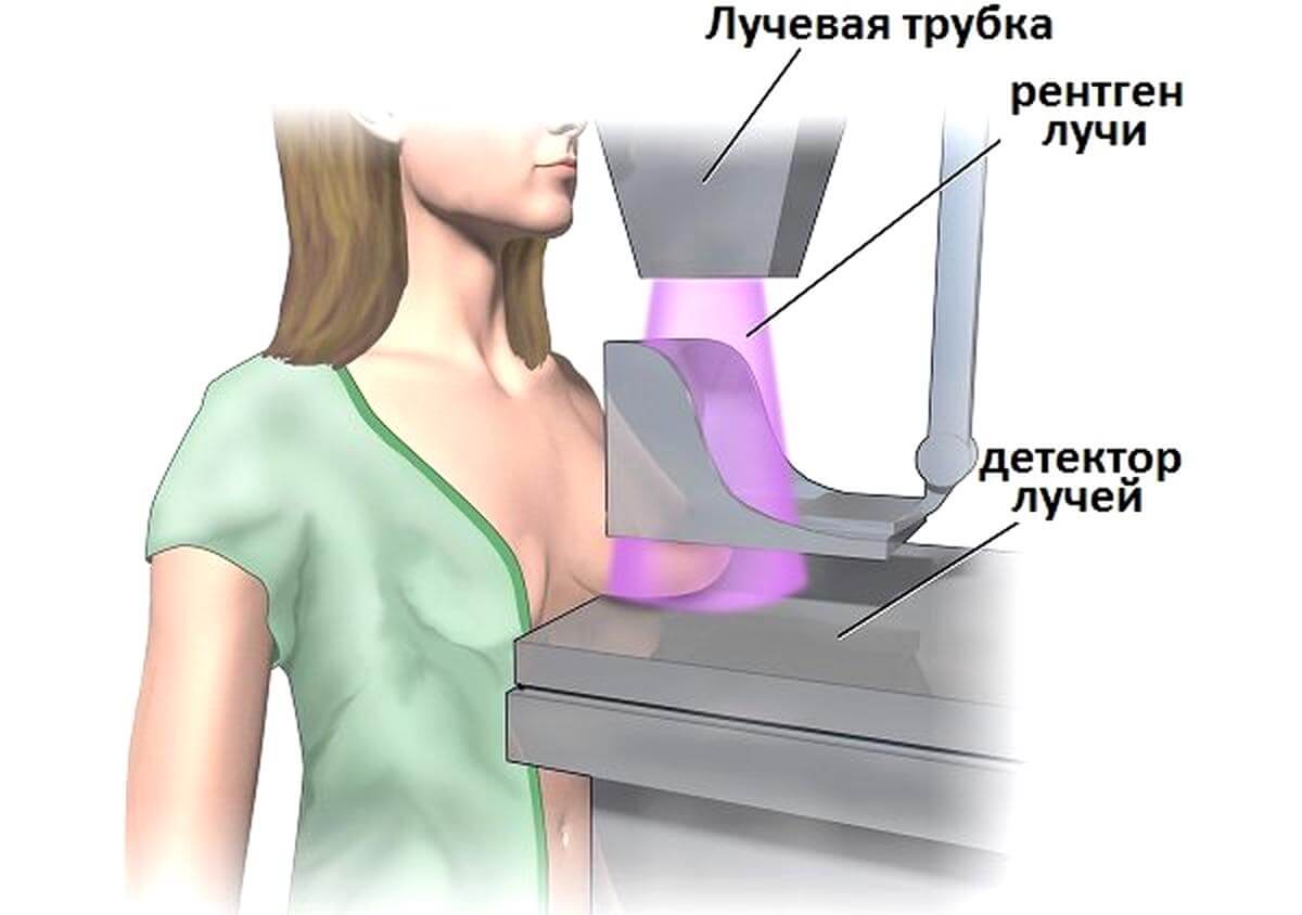 Аналоговая маммография: принцип метода исследования.