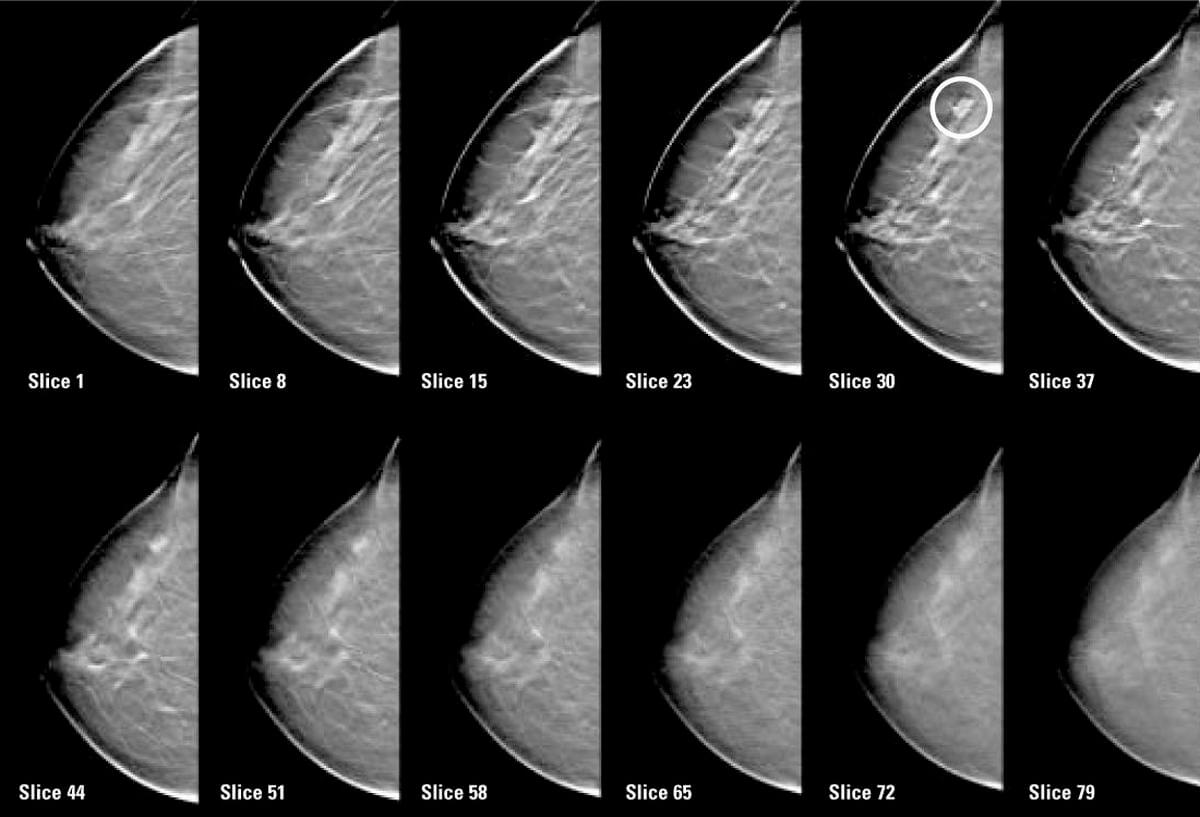 Послойные томограммы молочных желез при исследовании методом томосинтеза.