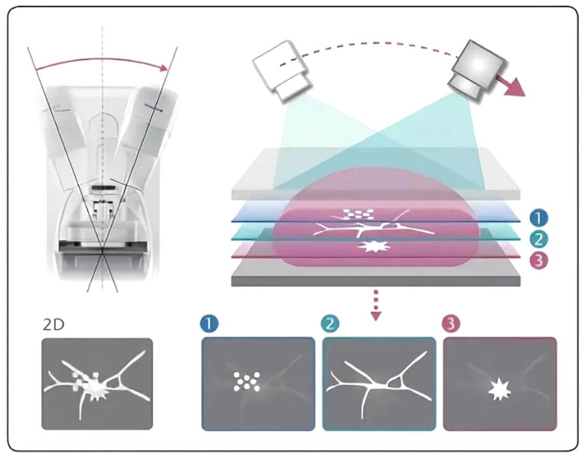 Томосинтез: визуализация внутренней структуры молочной железы.