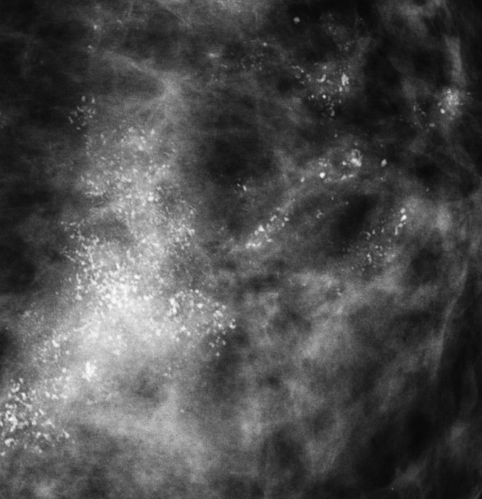 Рентгеновская цифровая маммограмма