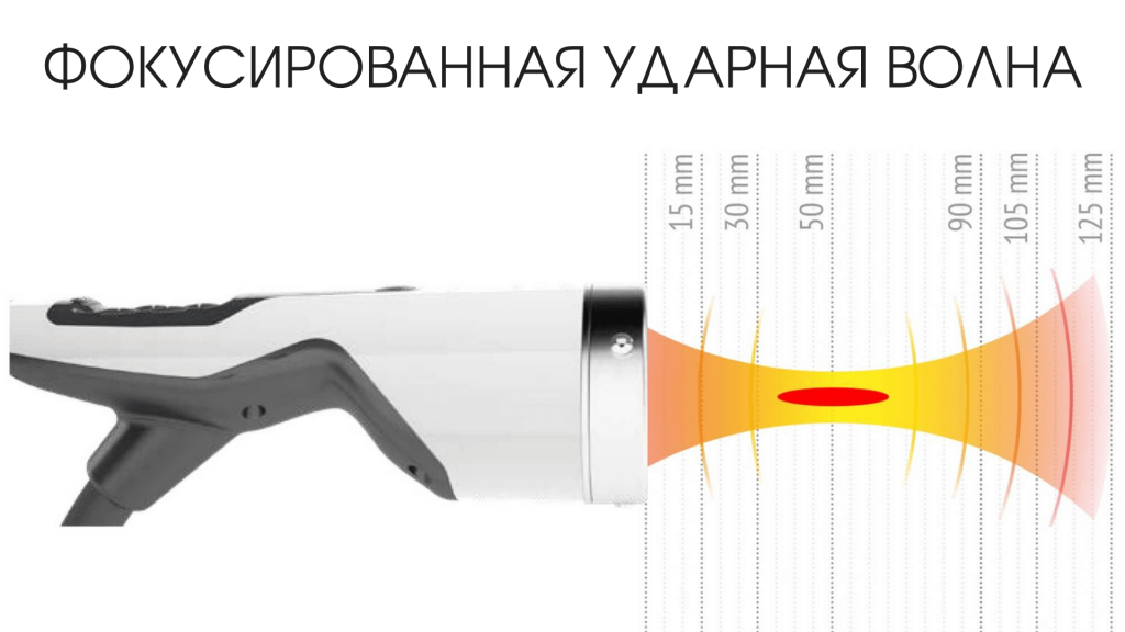 Конфигурация фокусированной ударной волны
