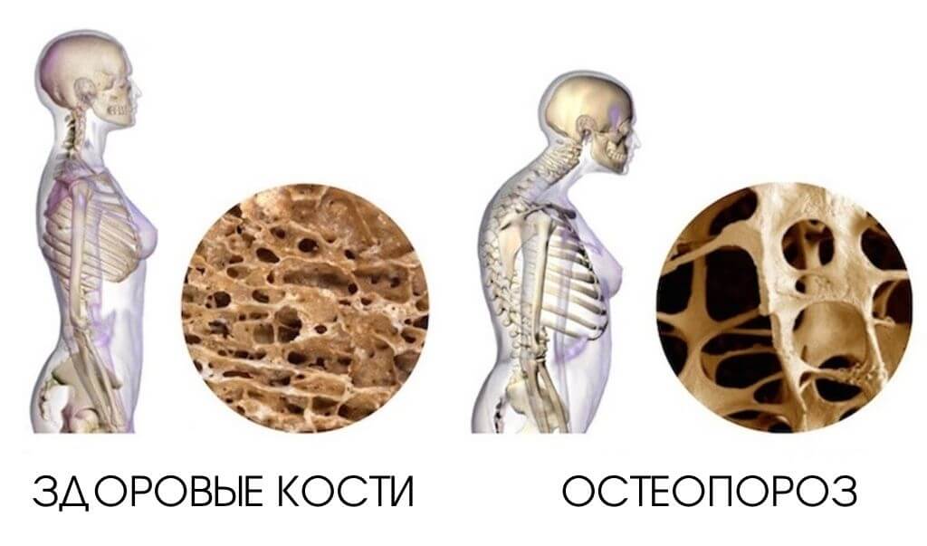 Остеопороз – вид заболевания костной ткани