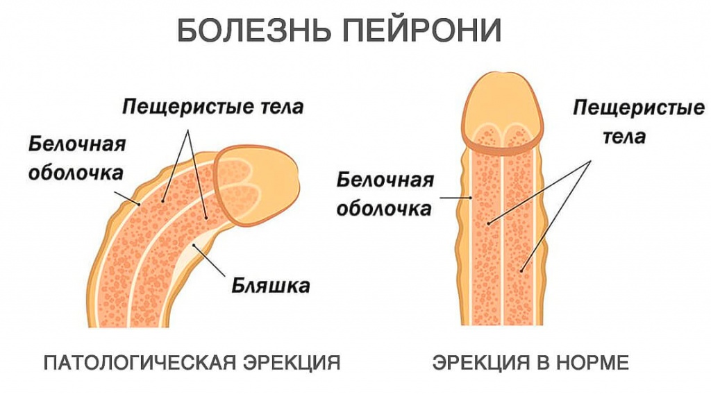 Болезнь Пейрони - особенности лечения аппаратом Duolith SD1 T-Top «F-SW Ultra»