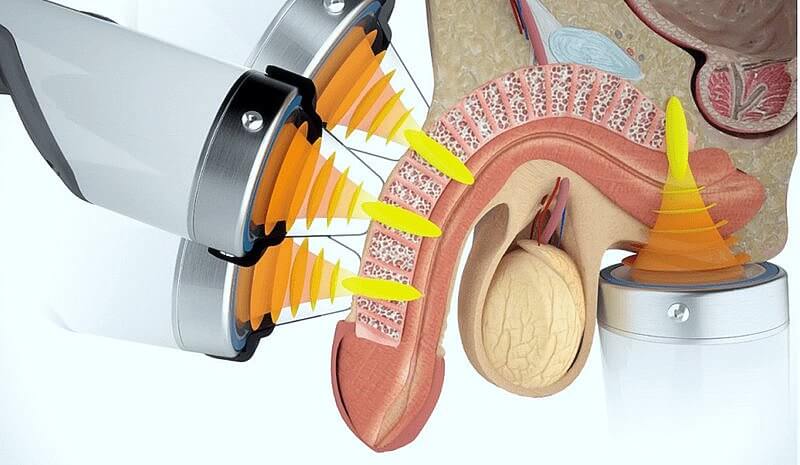 Лечение урологических патологий фокусированной волной на аппарате T-TOP «F-SW ULTRA» DUOLITH SD1: варианты позиционирования аппликатора 
