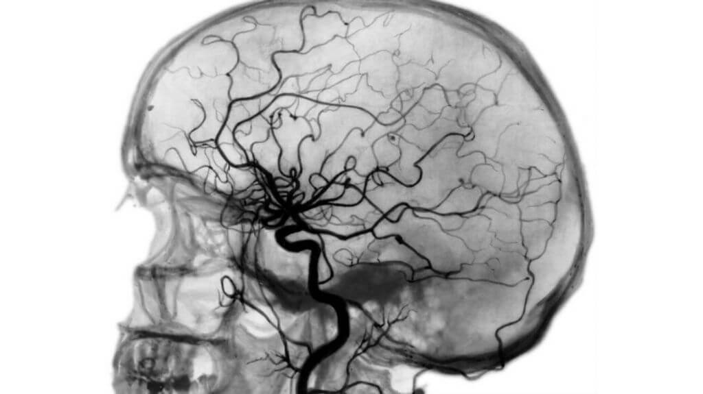 Снимок ангиографии