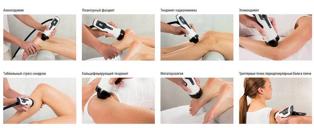 Варианты позиционирования «пистолета» F-SW «SEPIA» в травматологии, ортопедии, неврологии, спортивной и восстановительной медицине