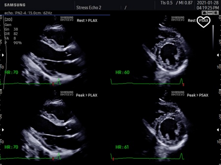 Аппарат УЗИ Samsung Medison HM70 EVO