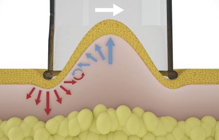 Система вакуумной терапии VACU-ACTOR