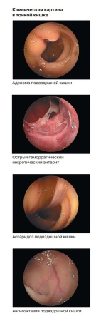 Двухбаллонная эндоскопическая система DBE Fujifilm