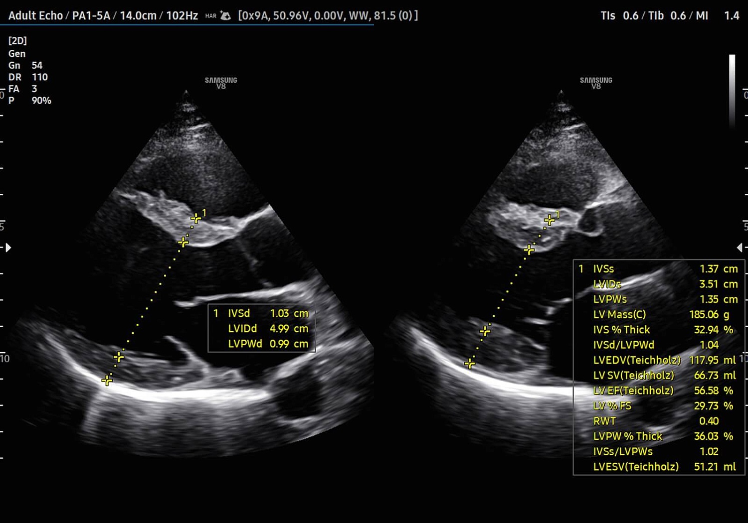 УЗИ аппарат Samsung Medison V8 на базе искусственного интеллекта