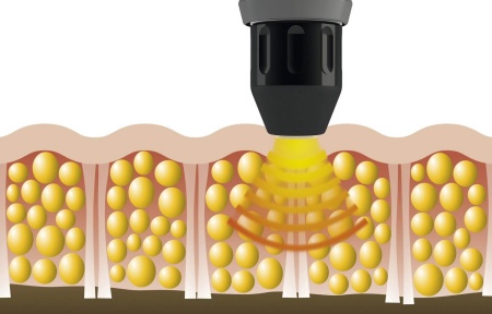 Аппарат ударно-волновой терапии MASTERPULS MP50 ULTRA