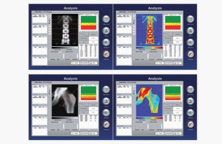 Рентгеновский костный денситометр DEXXUM 3 OsteoSys Рентгеновский костный денситометр DEXXUM 3 OsteoSys