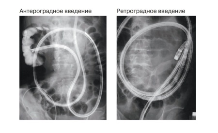 Двухбаллонная эндоскопическая система DBE Fujifilm