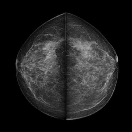 Аналоговый маммограф Genoray MX-600