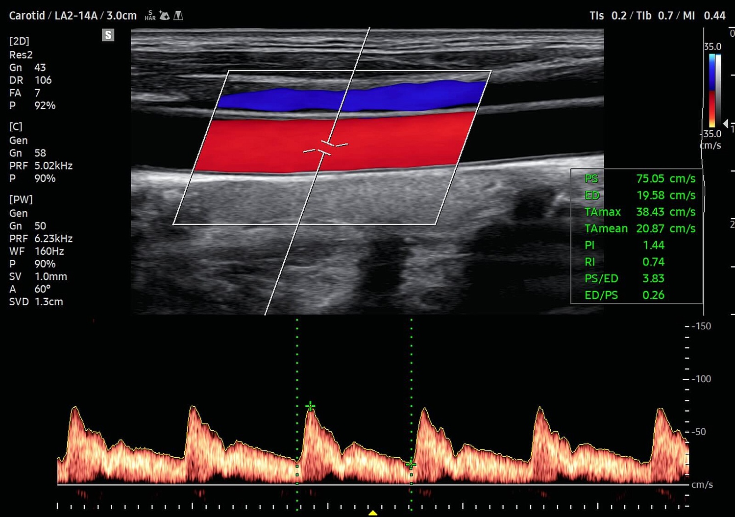 УЗИ аппарат Samsung Medison V8 на базе искусственного интеллекта