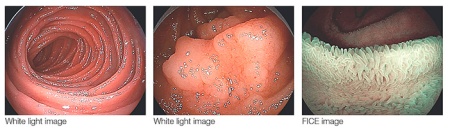 Видеоколоноскоп двухбаллонный Fujifilm EN-580XP