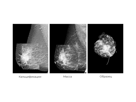 Цифровой маммограф Brestige Premium Direct