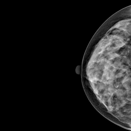 Цифровой маммограф Genoray DMX-600