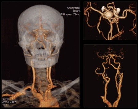 Компьютерный томограф NeuViz 64 Neusoft