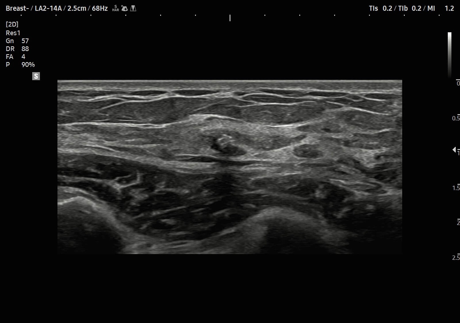 УЗИ аппарат Samsung Medison V8 на базе искусственного интеллекта