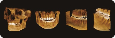 Дентальный томограф Genoray Papaya 3D без цефалостата