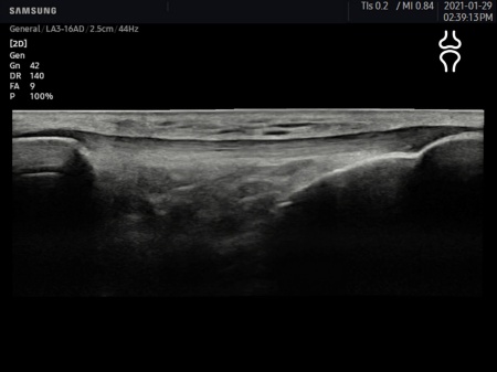 Аппарат УЗИ Samsung Medison HM70 EVO