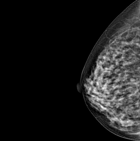 Цифровой маммограф Genoray DMX-600