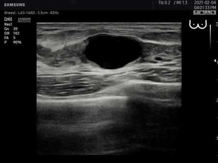 Аппарат УЗИ Samsung Medison HM70 EVO