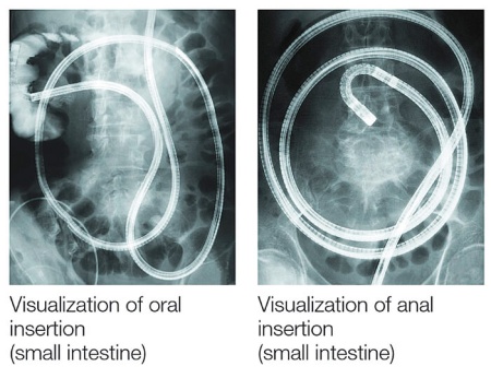 Видеоколоноскоп двухбаллонный Fujifilm EN-580XP
