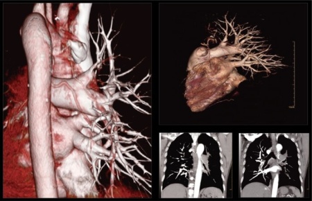 Компьютерный томограф NeuViz 64 Neusoft