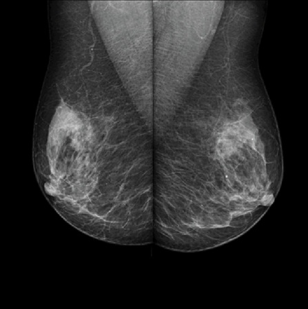 Аналоговый маммограф Genoray MX-600