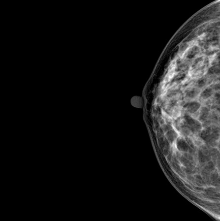 Цифровой маммограф Genoray DMX-600