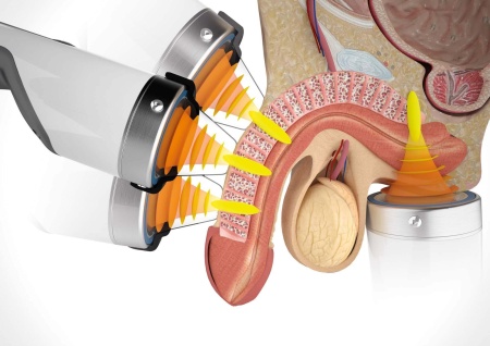 Аппарат ударно-волновой терапии Duolith SD1 T-Top «F-SW Ultra» для урологии