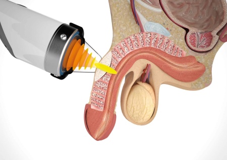 Аппарат ударно-волновой терапии Duolith SD1 T-Top «F-SW Ultra» для урологии