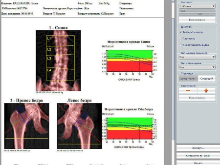 Рентгеновский костный денситометр Stratos DMS