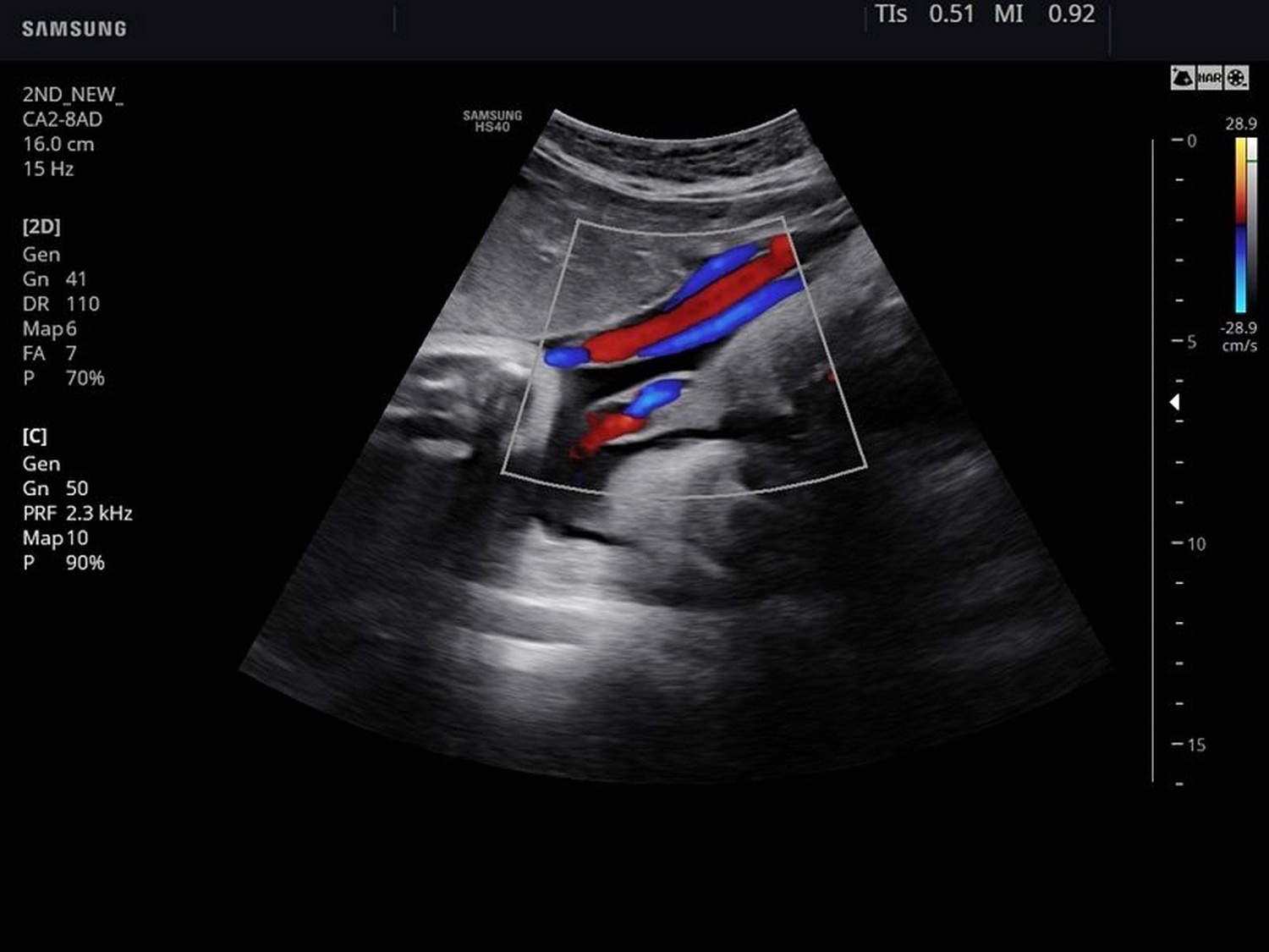 Аппарат УЗИ Samsung Medison HS40