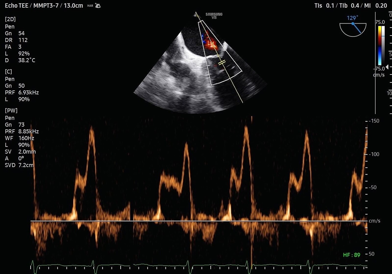 УЗИ аппарат Samsung Medison V8 на базе искусственного интеллекта