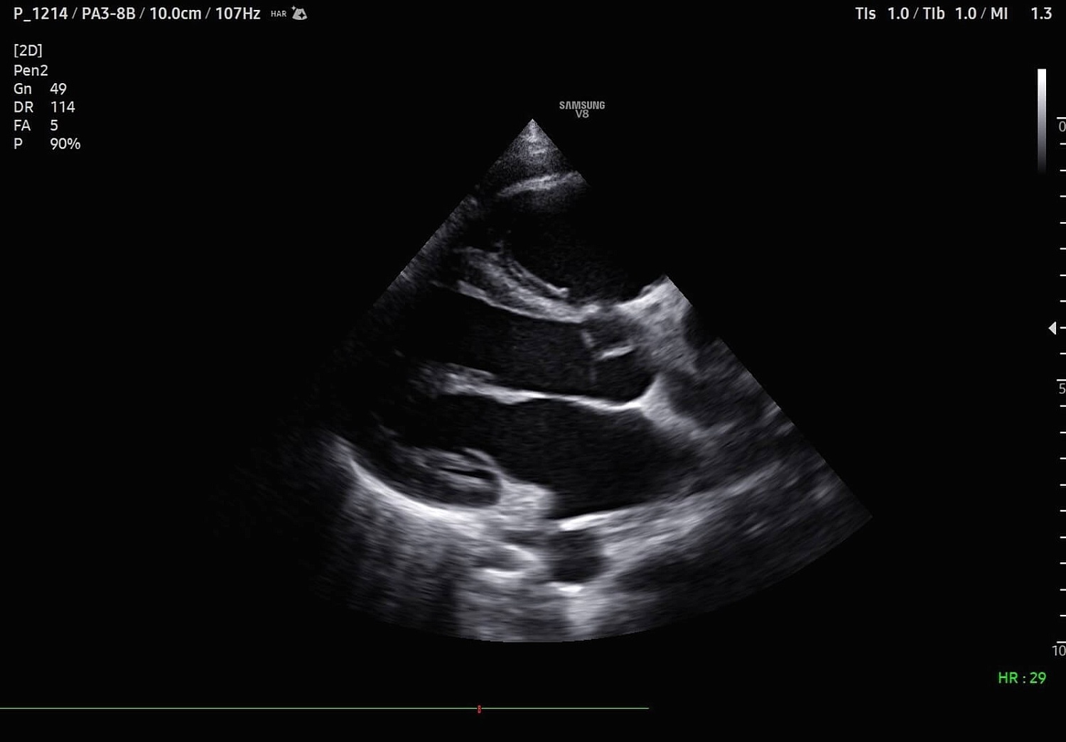 УЗИ аппарат Samsung Medison V8 на базе искусственного интеллекта