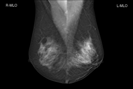 Аналоговый маммограф Genoray MX-600