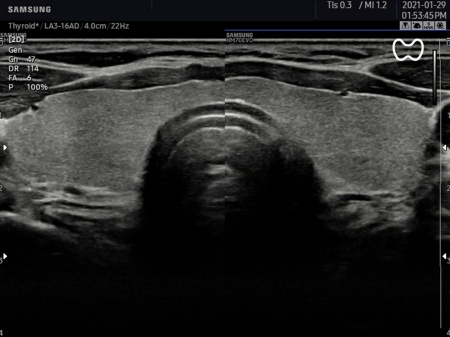 Аппарат УЗИ Samsung Medison HM70 EVO